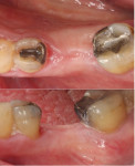 Fig 18. Clinical appearance of the soft tissue at 8 months post-surgery demonstrating non-inflamed gingival tissue and stable coronal position, occlusal view (top) and buccal view (bottom).