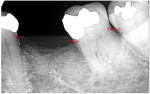 Fig 19. At 8 months post-surgery improvements in periodontal probing and bone gain were noted with No. 18 distal bone measurements reading 5.48 mm (a reduction from 7 mm), No. 18 mesial at 3.03 mm (from 12.74 mm), and No. 20 distal at 3.61 mm (from 5.96 mm) with elimination of the mobility initially present.