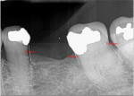 Fig 20. At 36 months post-surgery healthy pockets and bone gain were maintained with radiographic measurements at No. 18 distal = 5.16 mm, No. 18 mesial = 3.98 mm, and No. 20 distal = 4.38 mm with a continued absence of the mobility initially present.