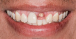 Fig 1. Preoperative photograph showing tooth No. 9 fractured at the gingival line with recurrent decay. Tooth No. 10
did not have any restorations.