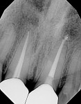 Fig 2. Preoperative radiograph showing an old defective crown that had fractured on
tooth No. 9. The remaining walls on the tooth appeared to be thin with a compromised prognosis.