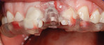 Fig 4. A 3D surgical guide was
fabricated utilizing a previously taken scan (Trios), planning software (Blue Sky Plan®, Blue Sky Bio), and 3D printing.