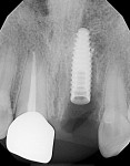 Fig 5. An implant (4.2 mm x 12 mm Tapered Pro, BioHorizons®) was placed at least 1 mm below the crestal bone and
5 mm away from the contact of the adjacent teeth.