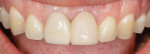 Fig 8.
Temporary crown on No. 9, which the patient wore for
4 months during the healing process of the implant.