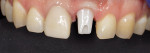 Fig 10. A zirconia abutment was used to
circumvent potential issues related to show-through
of metal color beneath the crown and graying of the
gingival tissue.