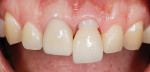 Fig 11. Because zirconia can be
susceptible to contamination from saliva, ZirClean®
(BISCO) was used to clean the crown before cementation
with TheraCem.