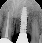 Fig 12. Postoperative radiograph,
captured at crown delivery, showcasing a
successful implant integration. The radiograph
demonstrates appropriate bone levels, affirming the
implant’s stability and long-term potential.