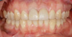 Fig 13.
Final outcome. Gingival tissues exhibited a healthy
appearance, underscoring successful treatment.
Adjustments were made to eliminate occlusal contacts
during excursive movements.