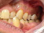 Fig 3. Pretreatment, left lateral intraoral view.