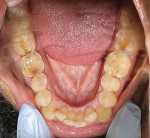 Fig 4. Pretreatment,
mandibular occlusal view.