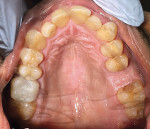 Fig 5. Pretreatment, maxillary occlusal view.