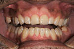 Fig 8. Post-treatment, open bite.