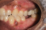 Fig 9. Post-treatment, left lateral intraoral view.