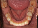 Fig 10. Post-treatment, mandibular occlusal view.