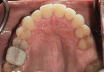 Fig 11. Post-treatment, maxillary occlusal view.