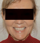 Fig 1. Pretreatment, full facial view.