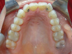 Fig 2. Pretreatment, maxillary occlusal view.