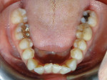 Fig 3. Pretreatment, mandibular
occlusal view.