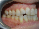 Fig 4. Pretreatment, right lateral intraoral view.