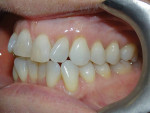 Fig 6. Pretreatment,
left lateral intraoral view.