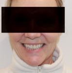 Fig 7. Post-treatment, full facial view.