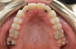 Fig 8. Post-treatment, maxillary occlusal view.