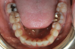 Fig 9. Post-treatment, mandibular
occlusal view.