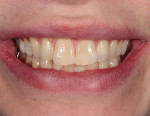 Fig 1. The patient was unhappy with her wide central incisors and the color, wear, and position of her teeth, which
looked aged beyond the patient’s years.