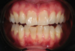 Fig 3. Pretreatment, front retracted view showing color and shape of central
incisors.