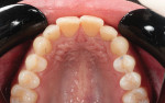 Fig 4. Pretreatment, maxillary occlusal view. The landmark point was the mesial aspect of tooth No. 9.