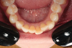 Fig 5.
Pretreatment, mandibular occlusal view. The landmark point was tooth No. 23.