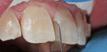 Fig 7. Accurate staged IPR was carried out using
bonded diamond files (SpaceFile®, Dentsply Sirona) and checked with leaf gauges.