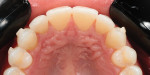 Fig 8. Detailed attachments
on maxillary dentition, used
to ensure predictable
outcomes.