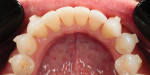 Fig 9. Detailed
attachments on mandibular
dentition.