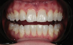 Fig 10. Front view
after the use of 18 aligners
and a few weeks of simultaneous
whitening.