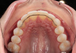 Fig 11.
Maxillary occlusal view at
6-month review.