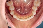 Fig 12.
Mandibular occlusal view at
6-month review.