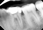 Fig 1 and
Fig 2. (Case
1) Preoperative
radiographs
showing
tooth No. 19
with a
separated
instrument
in the
mesiolingual
canal.