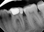 Fig 1 and
Fig 2. (Case
1) Preoperative
radiographs
showing
tooth No. 19
with a
separated
instrument
in the
mesiolingual
canal.