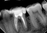 Fig 3.
Postoperative
radiograph.