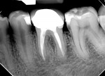 Fig 4 and Fig 5. (Case 1,
cont’d) At the 1-year
postoperative follow-up, a
complete healing of the
lesion was evident.