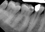 Fig 6.
(Case 2) Preoperative
radiograph. Tooth No. 30
had a deep carious lesion.
The tooth was percussion-
tender and lingering
to cold testing.