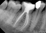 Fig 7.
Postoperative radiograph
showing adequate obturation
of tooth No. 30.