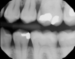 Fig 2. Bitewing radiograph taken at hygiene recall depicting
caries extent on tooth No. 14 several weeks before restorative procedure. Pulp testing elicited a non-lingering
hyper-response to cold.