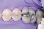 Fig 3. Rubber dam isolation prior to caries removal.