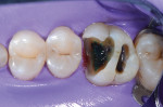 Fig 4. Selective caries removal was
performed using a caries indicator (Sable™ Seek™, Ultradent). A small area of affected dentin was left surrounded by
a ≥2 mm periphery of sound dentin.