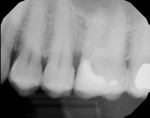 Fig 10. Postoperative radiograph
showing restoration after cementation with G-CEM ONE. Isolation techniques employed allowed for seamless
transitions between all substrates involved.