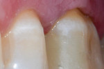 Fig 11. Mesial/buccal view, immediate postoperative. Favorable margin
adaptation was obtained with both the composite margin elevation and the milled LiSi block.