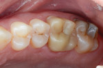 Fig 12. Final restoration
at several months’ recall. Satisfactory esthetics were achieved using fine diamond burs and rubber ceramic polishing
wheels. No glaze, stain, or crystallization cycle was used.