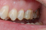 Fig 13. At recall, good buccal shade integration after tooth
rehydration was evident. The beveled enamel margin allowed for seamless blending of translucent monolithic
materials while conserving tooth structure.